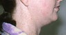 Neck Liposuction