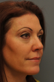 Fat Transfer to the Face