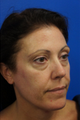 Fat Transfer to the Face