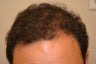 Hair Transplantation in Man