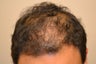 Hair Transplantation in Man