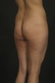 Brazilian Butt Lift