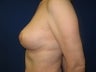 Breast Lift