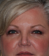 Ultherapy