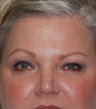 Ultherapy