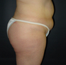 Butt Augmentation