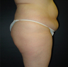 Butt Augmentation