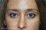 Upper and Lower Blepharoplasty (eyelid surgery) to awaken eyes