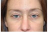Upper and Lower Blepharoplasty (eyelid surgery) to awaken eyes