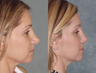 Revision Rhinoplasty