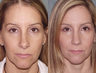 Revision Rhinoplasty