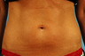 truSculpt