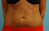 truSculpt