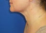Laser Liposuction