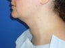 Laser Liposuction