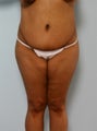 Body Lift