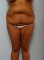 Body Lift