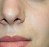 Mole Removal
