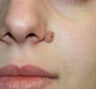Mole Removal
