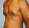 Male Breast Reduction on 15 year old