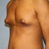 Male Breast Reduction on 15 year old