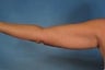 Arm Lift