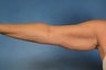 Arm Lift