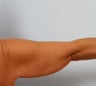 Arm Lift