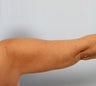 Arm Lift