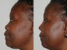 54 Year Old African American Primary Rhinoplasty