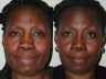 54 Year Old African American Primary Rhinoplasty