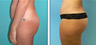 Brazilian Butt Lift Before & After