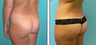 Brazilian Butt Lift Before & After