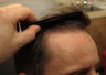 FUE ARTAs robotic hair transplantation