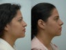 Nose Surgery / Rhinoplasty