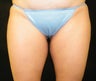 CoolSculpting