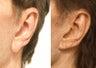 Earlobe Reduction