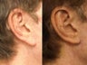 Earlobe Reduction