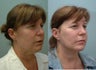 Facelift