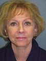 LiteLift™ / Face Lift on 74-year-old Woman
