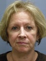 LiteLift™ / Face Lift on 74-year-old Woman