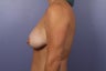 42 yr old wanting mommy makeover