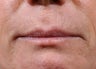 Lip Implant