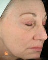 Female treated with 3 Photodynamic Therapy with Levulan for sun damage