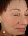 Female treated with 3 Photodynamic Therapy with Levulan for sun damage