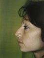 Rhinoplasty