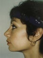 Rhinoplasty
