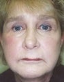 Female patient who underwent liposuction