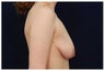 Breast Lift