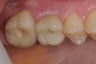 Single implant to replace upper molar